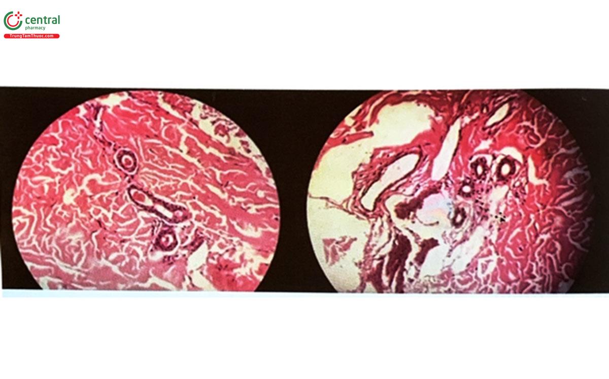 Hình 3.12. Hình ảnh giải phẫu bệnh cho thấy mao mạch giãn, nhiều hồng cầu trong tuyến mồ hôi trên bệnh nhân L, Hà Nội (Nguồn: tác giả)