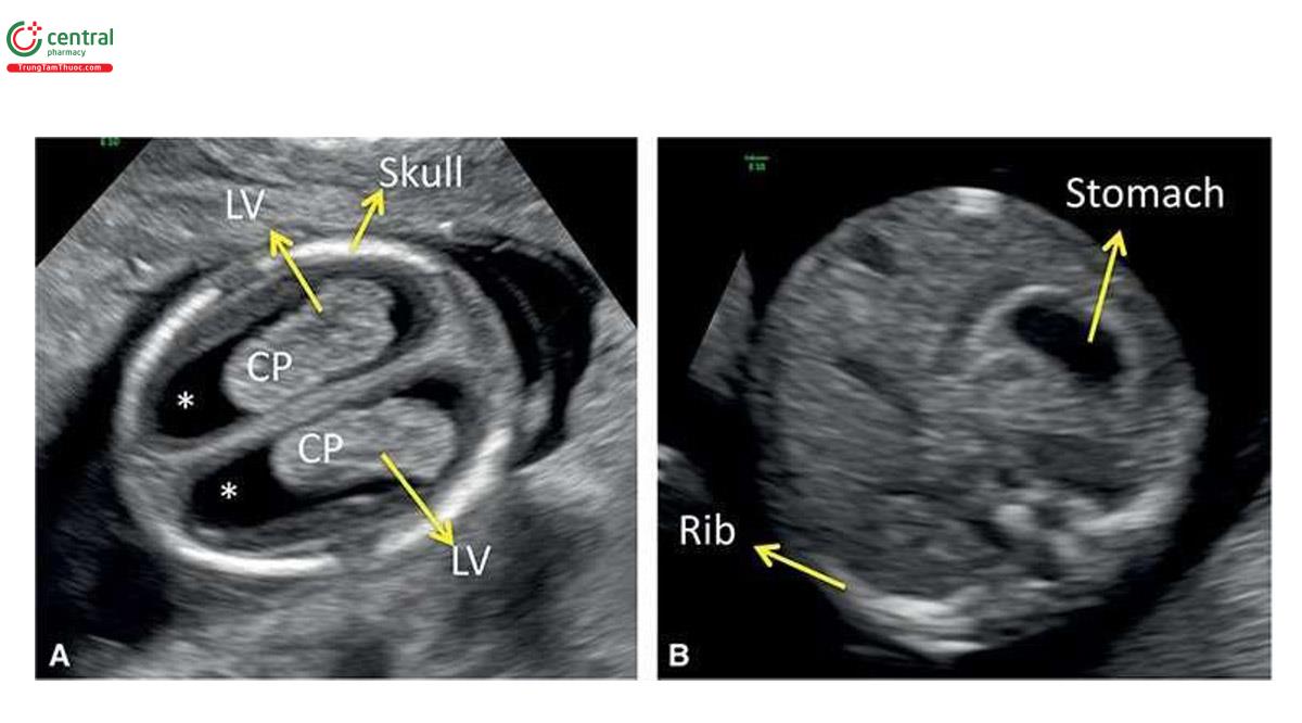Hình 2.1: Hình ảnh siêu âm đầu (A) và bụng (B) thai nhi 13 tuần tuổi. Lưu ý, xương hộp sọ tăng âm và dịch trống âm (dấu hoa thị) trong não thất bên (LV). Lưu ý, độ hồi âm của đám rối màng mạch (CP) kém hơn xương. Ở B, thấy xương sườn tăng âm và dịch trống âm trong dạ dày thai nhi.
