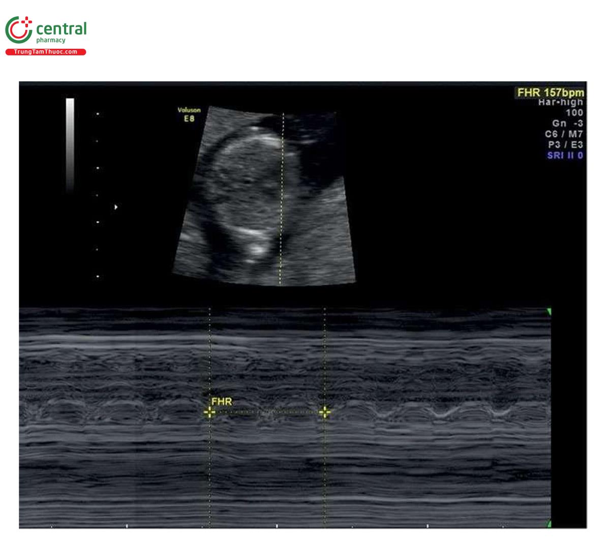 Hình 2.3: Siêu âm M-mode tim thai ở thai nhi 12 tuần tuổi. Lưu ý, đường M-mode cắt qua tim và hoạt động tim thai được hiển thị trên phố M-mode. Đây là mode được ưu tiên (cùng với lưu một đoạn phim ở B-mode) để ghi lại hoạt động tim thai trong quý 1 vì nó mang ít năng lượng hơn Doppler xung. Lưu ý, tần số tim thai đo được là 157 nhịp/phút.