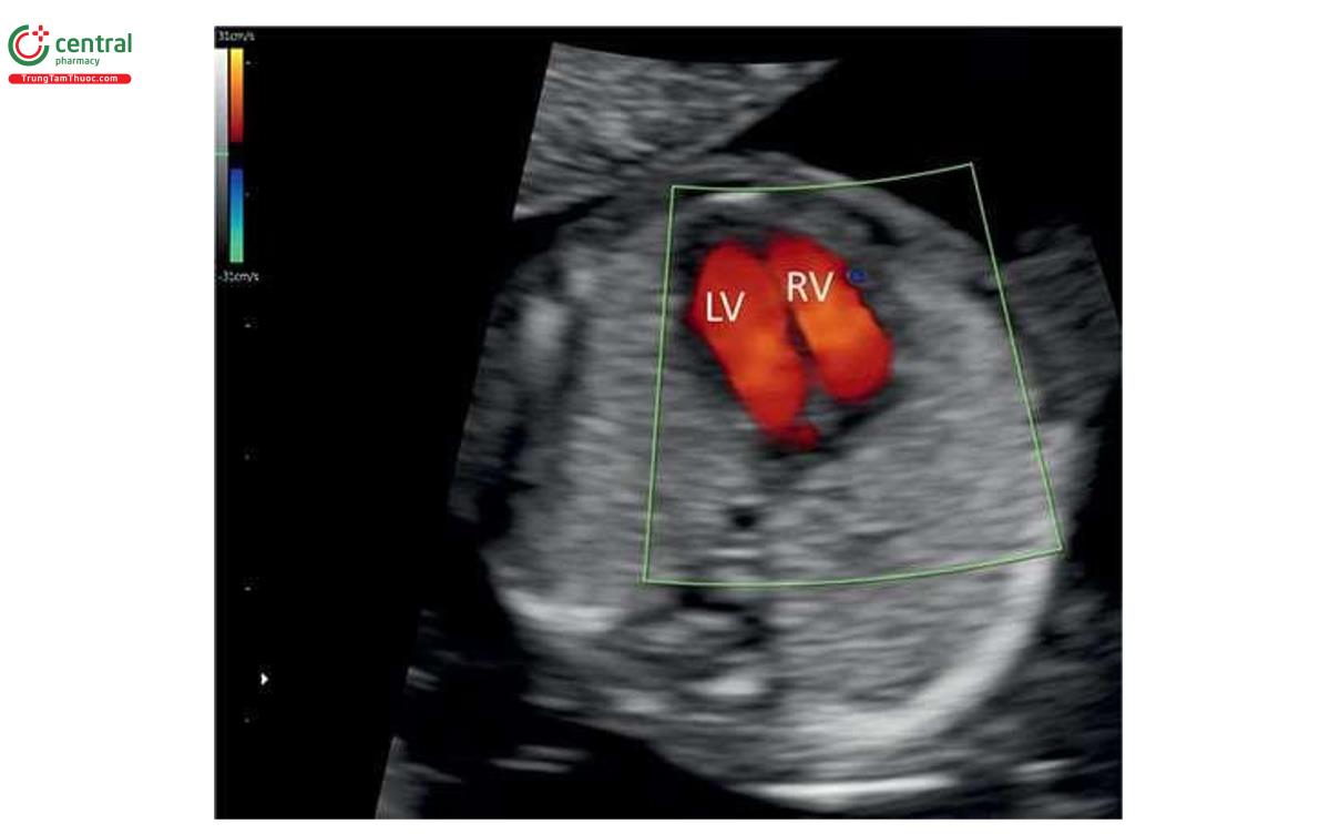 Hình 2.6: Mode Doppler màu mặt cắt bốn buồng của thai nhi 14 tuần tuổi. Dòng máu trong tim thai có vận tốc cao và nên phải dùng thang vận tốc màu cao (ở đây là 33 cm/giây). LV, tâm thất trái; RV, tâm thất phải.