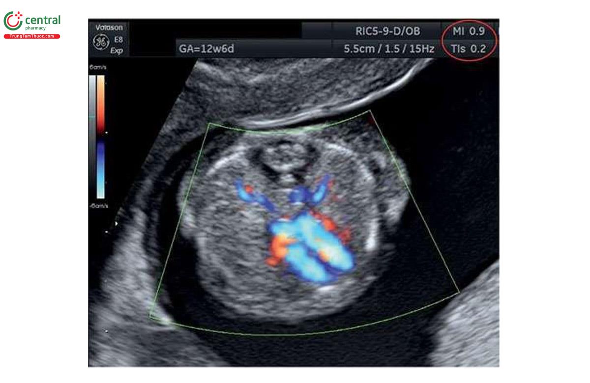 Hình 2.9: Mặt cắt bốn buồng ở thai nhi 13 tuần tuổi với siêu âm Doppler màu. Lưu ý, MI và TI được hiển thị trong vòng tròn màu đỏ. Chỉ số cơ (MI) và chỉ số nhiệt mô mềm (TIS). TIS rất hữu ích trong quý 1 do cấu trúc xương chưa cốt hóa. Xem văn bản để biết thêm chi tiết.