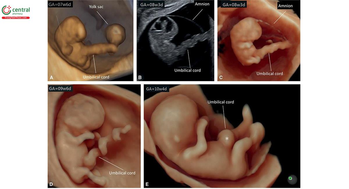 Hình 15.10: Siêu âm 3D ở chế độ bề mặt (surface mode) (A, C - E) và siêu âm 2D (B) của phôi và dây rốn từ 7 đến 10 tuần tuổi. Lưu ý, dây rốn ở khoảng tuổi thai này ngắn và dày và kết nối phôi với bánh nhau. Lưu ý ở E, lúc 10 tuần tuổi, dây rốn dày ở vị trí cắm vào ổ bụng (dấu hoa thị), tương ứng với thoát vị sinh lý (physiologic hernia).
