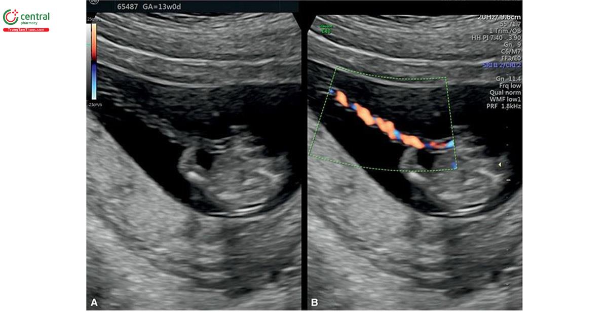 Hình 15.11: Siêu âm 2D (A) và Doppler màu (B) của dây rốn ở thai kỳ 13 tuần tuổi. Lưu ý ở A và B, dây rốn dài ra và mỏng dần từ lúc 7 đến 10 tuần tuổi (Hình 15.10). Dây rốn lúc 13 tuần tuổi có đặc điểm giống như trong quý 2.