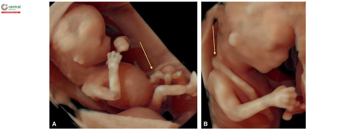 Hình 15.13: Siêu âm 3D + chế độ bề mặt (surface mode) ở 2 thai nhi 12 (A) và 13 (B) tuần tuổi cho thấy giải phẫu bên ngoài thai nhi cùng với dây rốn (mũi tên).