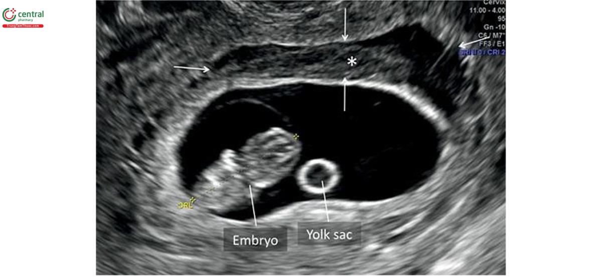 Hình 15.14: Siêu âm 2D ở thai kỳ 9 tuần tuổi cho thấy khối máu tụ dưới màng đệm (subchorionic hematoma) (dấu hoa thị và các mũi tên) nằm giữa màng đệm và thành tử cung.