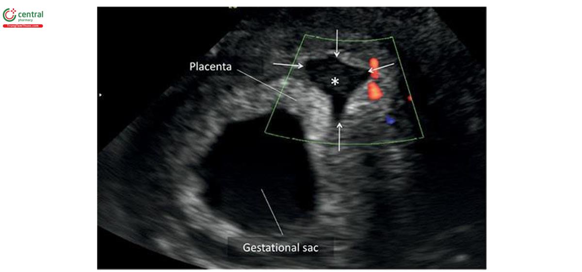 Hình 15.15: Siêu âm 2D với Doppler màu ở thai kỳ 10 tuần tuổi cho thấy khối máu tụ sau nhau (retroplacental hematoma) (dấu hoa thị và các mũi tên) nằm sau bánh nhau.