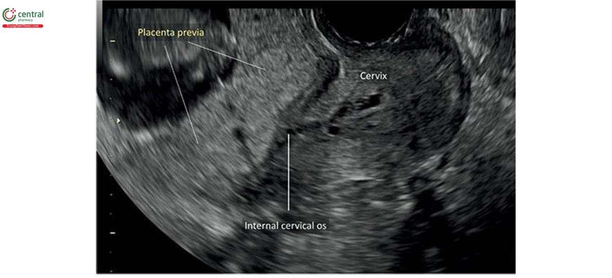Hình 15.17: Siêu âm 2D qua ngả âm đạo ở thai kỳ 12 tuần tuổi cho thấy nhau tiền đạo. Lưu ý, nhau đang che phủ lỗi trong cổ tử cung.