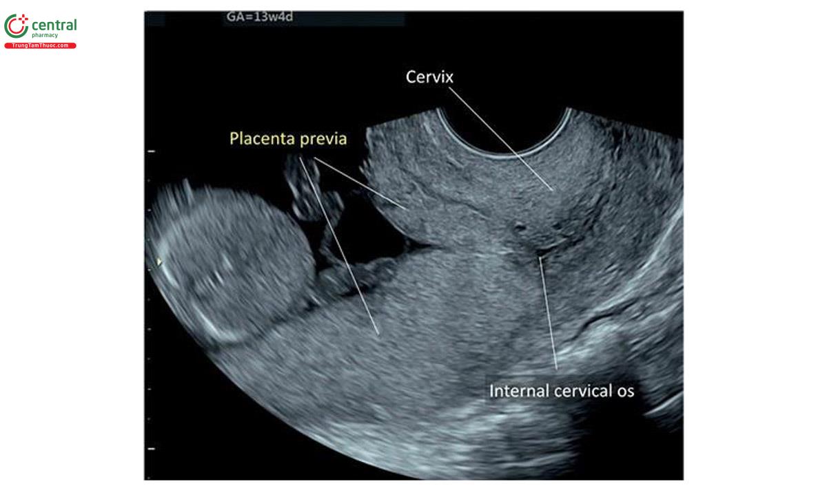 Hình 15.18: Siêu âm 2D qua ngả âm đạo ở thai kỳ 13 tuần tuổi cho thấy nhau tiền đạo. Lưu ý, nhau đang che phủ lỗi trong cổ tử cung.
