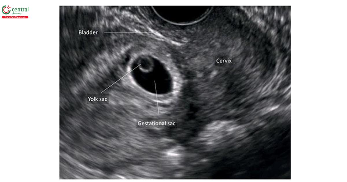 Hình 15.20: Siêu âm qua ngả âm đạo, mặt cắt dọc giữa tử cung ở thai kỳ 7 tuần tuổi cho thấy thai chăm sóc se se thai. Lưu ý, túi thai nằm sâu trong se sel get thai. Cũng cần lưu ý, bàn quang trống gần với túi thai.