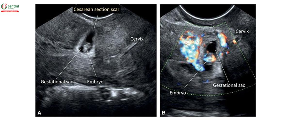 Hình 15.21: Siêu âm qua ngả âm đạo, mặt cắt dọc giữa tử cung trên siêu âm 2D (A) và Doppler màu (B) ở thai kỳ 7 tuần tuổi cho thấy thai chăm sóc săn lùng thai. Lưu ý, túi thai nằm sâu trong se sel get thai. Cũng cần lưu ý, túi thai có dạng hình thoi ở A và B. Doppler màu cho thấy tăng sinh mạch máu xung quanh túi thai.