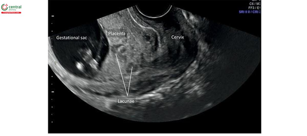 Hình 15.23: Siêu âm qua ngả âm đạo ở thai kỳ 13 tuần tuổi cho thấy có nhiều ngọc (lacunae) trong bánh nhau và nhau tiền đạo ở một bệnh nhân có tiền sử dụng hái thai 2 lần trước đó. Sự hiện diện nhau tiền đạo với nhiều thỏ trong quý 1 làm tăng nguy cơ nhau thai accreta.