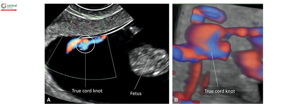 Hình 15.25: Siêu âm 2D (A) và 3D (B) với Doppler màu ở thai nhi 12 tuần tuổi có dây huy chương nút thực sự. Lưu ý ở A, dây dày trên Doppler color. Dây dày hô (vòng tròn) tiền ý dây kèn nút thực sự. B: Siêu âm 3D + chế độ thân kính của dây loa cho thấy dây rốn nút.