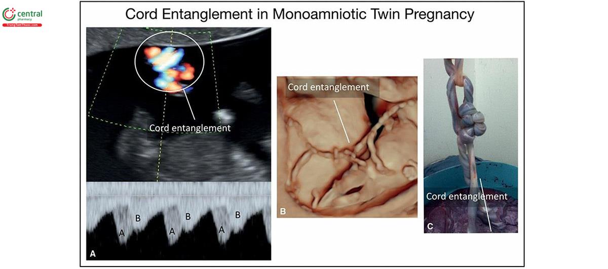 Hình 15.26: A: Doppler màu và xung của dây rốn câu nhau trong song thai một túi ối (mang thai đôi một ối) ở 13 tuần tuổi. Lưu ý, thấy "một khối dây rốn" trên Doppler màu chóp mũi dự đoán. Doppler xung khối dây âm thanh và ở hình A phía dưới cho thấy 2 phổ Doppler tên thai nhi lồng vào nhau (A và B trong Doppler), xác nhận dây rốn nhau B: Siêu âm 3D ở chế độ bề mặt (chế độ bề mặt) của một trường hợp song thai một túi tiền khác lúc 12 tuần tuổi có dây rốn nhau. thái kỳ ở B sau sinh lúc 33 tuần tuổi.