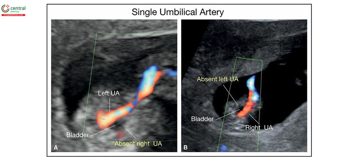 Hình 15.27: Mặt cắt ngang tiểu khung với Doppler màu ở 2 thái nhi (A và B) 13 tuần tuổi với động huy hiệu duy nhất. Lưu ý ở A, không có âm thanh bên phải (UA) và ở B, không có UA bên trái. Mặc dù các nghiên cứu trước đó đánh động huy động huy hiệu duy nhất ở bên nào thì có ý nghĩa, nhưng điều này không được chứng minh trong các nghiên cứu sau đó.