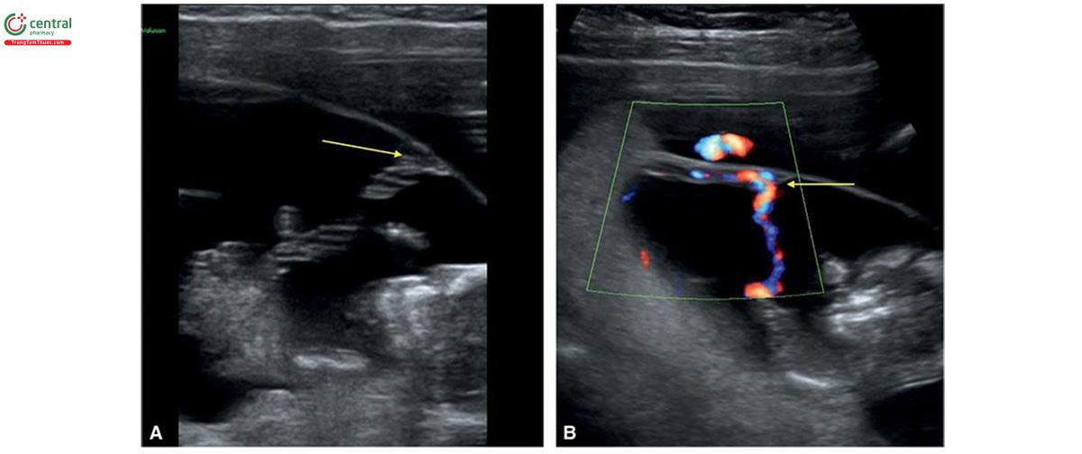 Hình 15.29: Siêu âm 2D (A) và Doppler màu (B) của một bài hát thai 12 tuần tuổi với dây âm thanh tiền khuếch cách (mũi tên). Chuỗi tiền thoại thường gặp hơn trong đa số Thái Lan. Xem văn bản để biết thêm chi tiết.
