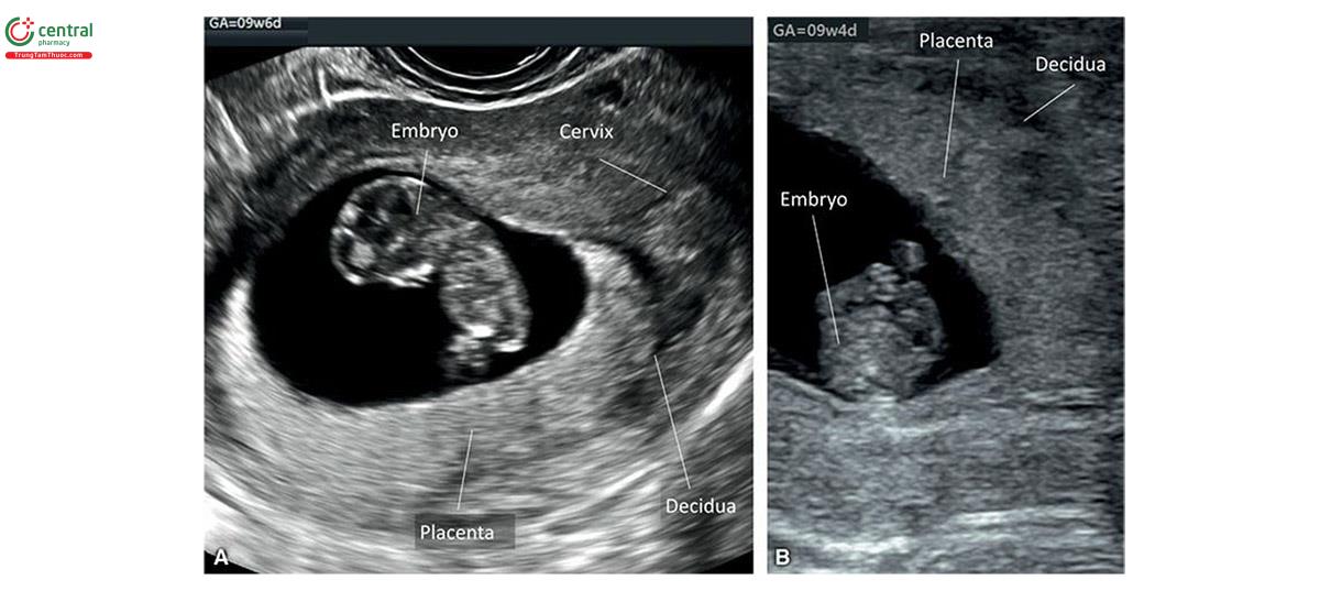 Hình 15.3: Siêu âm 2D ở 2 thai kỳ (A và B) lúc 9 tuần tuổi cho thấy nhau thai. Lưu ý, nhau thai hồi âm hơn một chút so với nội mạc tử cung xung quanh. Màng rụng (nội mạc tử cung nằm sau nhau thai) giảm âm.
