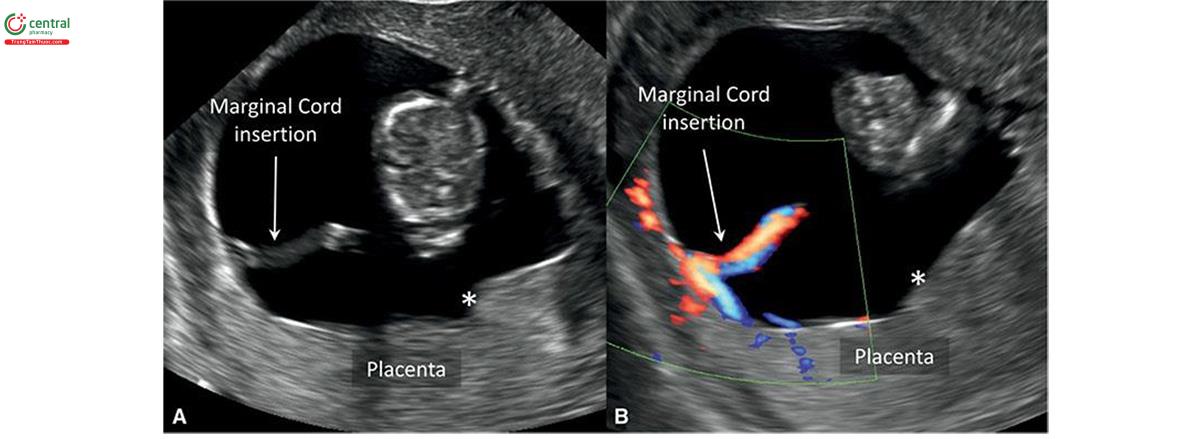 Hình 15.30: Siêu âm 2D (A) và Doppler màu (B) của thai kỳ 11 tuần tuổi có dây rốn viền mép. Lưu ý, dây huy động vào viền bên của bánh nhau thay vì trung tâm (dấu hoa thị).