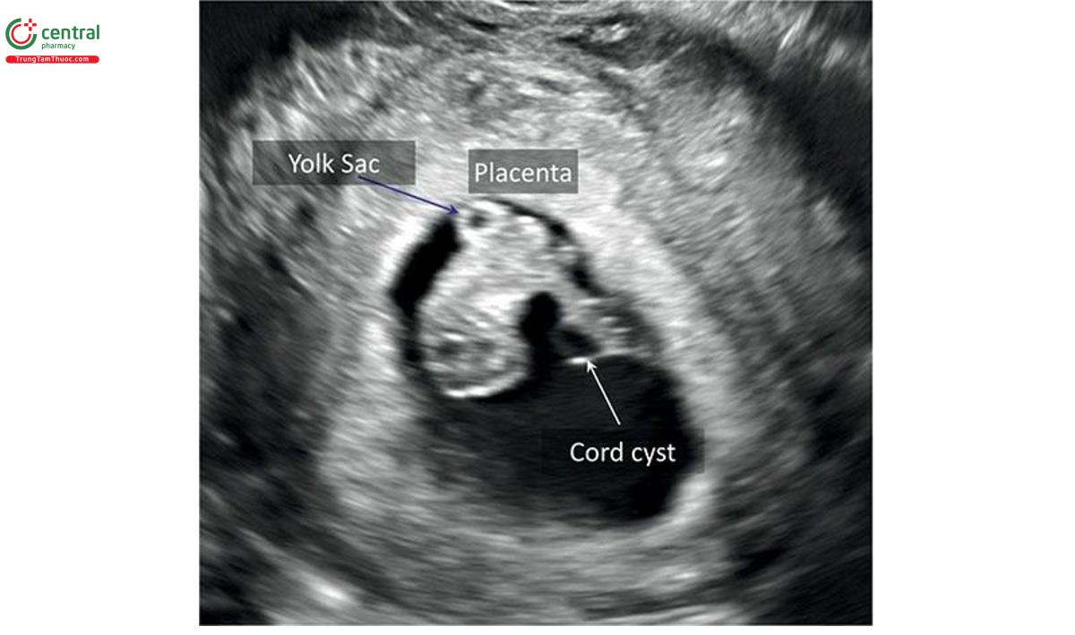 Hình 15.32: Siêu âm 2D của thai kỳ 9 tuần tuổi có nang dây rốn. Lưu ý, vị trí dây rốn gần với vị trí dây rốn vào bánh nhau. Xem hình ảnh siêu âm 3D tương ứng ở Hình 15.33.