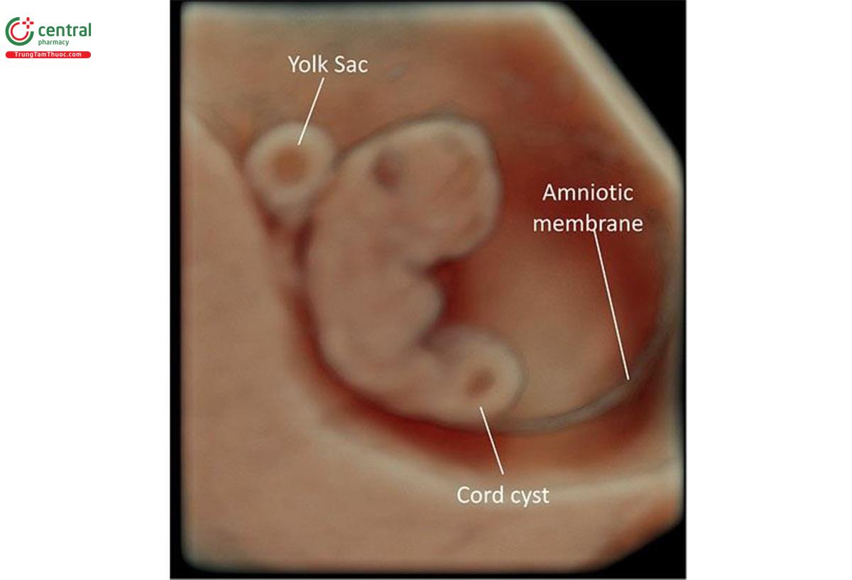 Hình 15.33: Siêu âm 3D của cùng một thai nhi ở Hình 15.32 có nang dây âm lúc 9 tuần tuổi. Thấy nang dây thanh trong khoảng đi ngược lại, túi noãn hoàng bên ngoài khoảng thời gian.