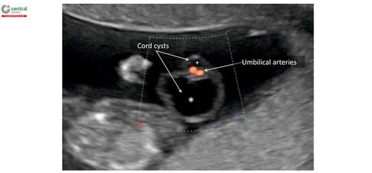 Hình 15.34: Siêu âm Doppler màu của một thai kỳ 13 tuần tuổi có 2 nang dây âm. Lưu ý, các dòng dây rốn có kích thước khác nhau với 1 nang lớn (dấu hoa thị) và 1 nang nhỏ (dấu cộng). Doppler màu cho thấy dây âm thanh có 2 mạch.