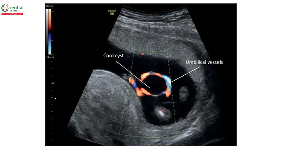 Hình 15.35: Siêu âm Doppler màu của thai kỳ 13 tuần tuổi có nang dây rốn. Lưu ý, trên Doppler màu mạch máu dây bao quanh nang.