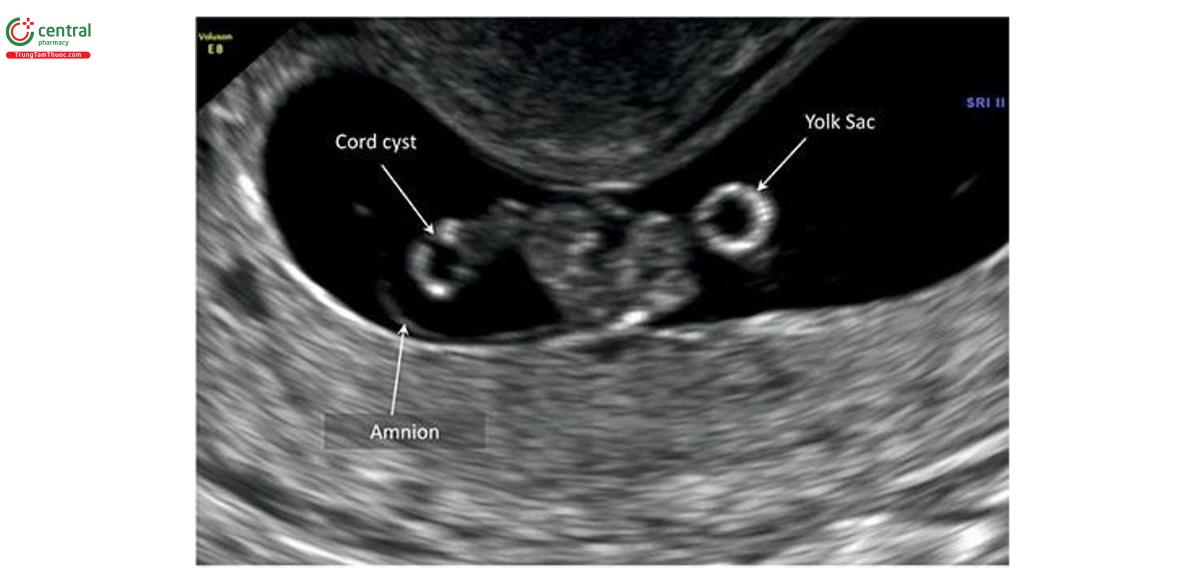 Hình 15.36: Siêu âm 2D của thai nhi 8 tuần tuổi có nang dây rốn. Lưu ý, thấy nang âm thanh trong khoảng ối ngược lại, túi noãn hoàng bên ngoài khoảng ối. So sánh Hình 15.32 và 15.33.