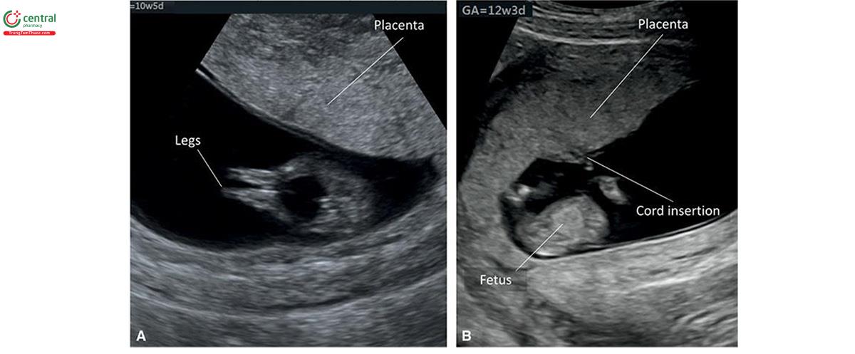 Hình 15.4: Siêu âm 2D ở 2 thai kỳ tương ứng lúc 10 (A) và 12 (B) tuần tuổi, cho thấy nhau thai. Lưu ý, nhau thai ở A và B có cấu trúc âm đồng nhất và hồi âm hơn một chút so với nội mạc tử cung và thành tử cung xung quanh. Vị trí dây rốn cắm vào nhau thai cho thấy ở B.