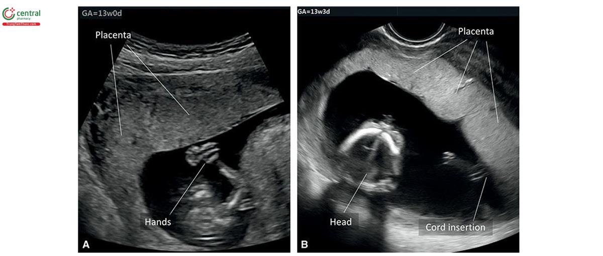 Hình 15.5: Siêu âm 2D ở 2 thai kỳ (A và B) lúc 13 tuần tuổi, cho thấy nhau thai. A: Hình ảnh thu được khi siêu âm qua thành bụng. B: Hình ảnh thu được khi siêu âm qua ngả âm đạo. Lưu ý, siêu âm qua ngả âm đạo cho thấy rõ nét các đường viền của nhau thai vì đầu dò có độ phân giải cao hơn. Vị trí dây rốn cắm vào nhau thai cho thấy ở B.