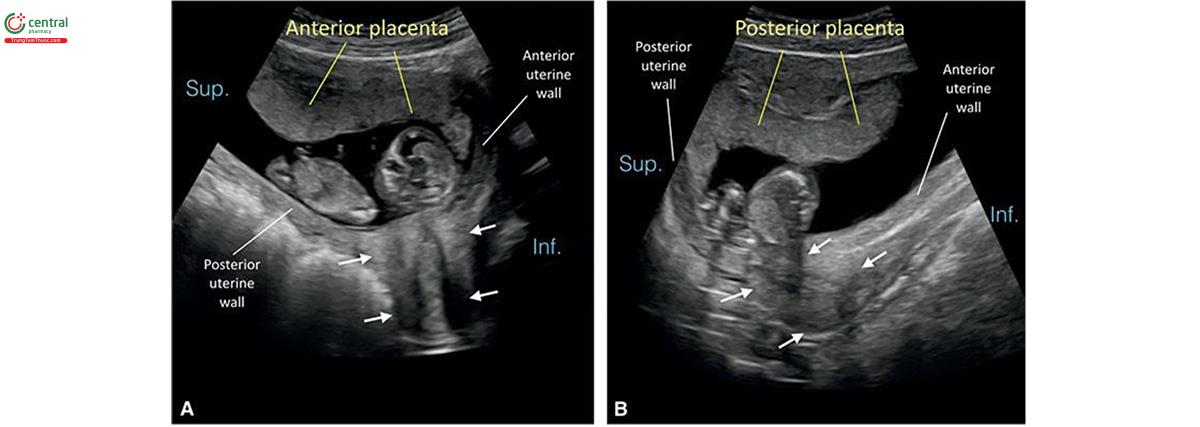 Hình 15.6: Vị trí bánh nhau trong quý 1 được mô tả tốt nhất sau khi xác định vị trí cổ tử cung (mũi tên) và thành trước / thành sau tử cung. Siêu âm qua thành bụng ở 2 thai kỳ (A và B), bánh nhau dường như ở thành trước tử cung. Ở A, bánh nhau ở mặt trước; tuy nhiên, ở B, vì tử cung gập trước (anteflexion), nên thành sau tử cung gần đầu dò nhất, và do đó bánh nhau ở mặt sau. Inf, Dưới; Sup, Trên.