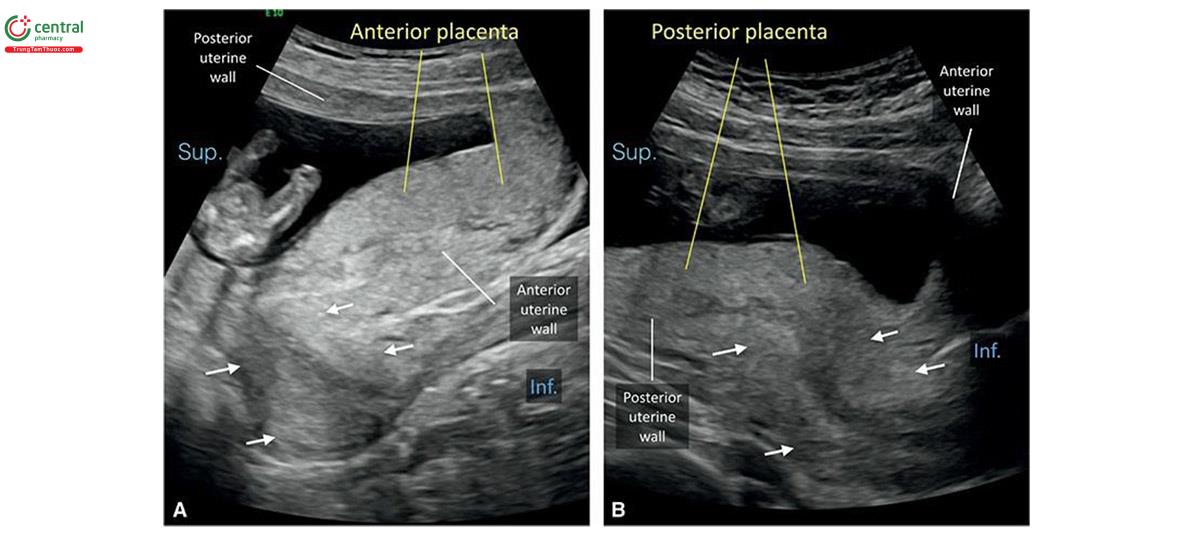 Hình 15.7: Vị trí bánh nhau trong quý 1 được mô tả tốt nhất sau khi xác định vị trí cổ tử cung (mũi tên) và thành trước / thành sau tử cung. Siêu âm qua thành bụng ở 2 thai kỳ (A và B), bánh nhau dường như ở thành sau tử cung. Ở A, bánh nhau ở mặt trước, và do tử cung gập trước (anteflexion) tạo ra một ấn tượng sai lầm về vị trí bánh nhau ở mặt sau. Ở B, vị trí bánh nhau rõ ràng ở mặt sau. Inf, Dưới; Sup, Trên.