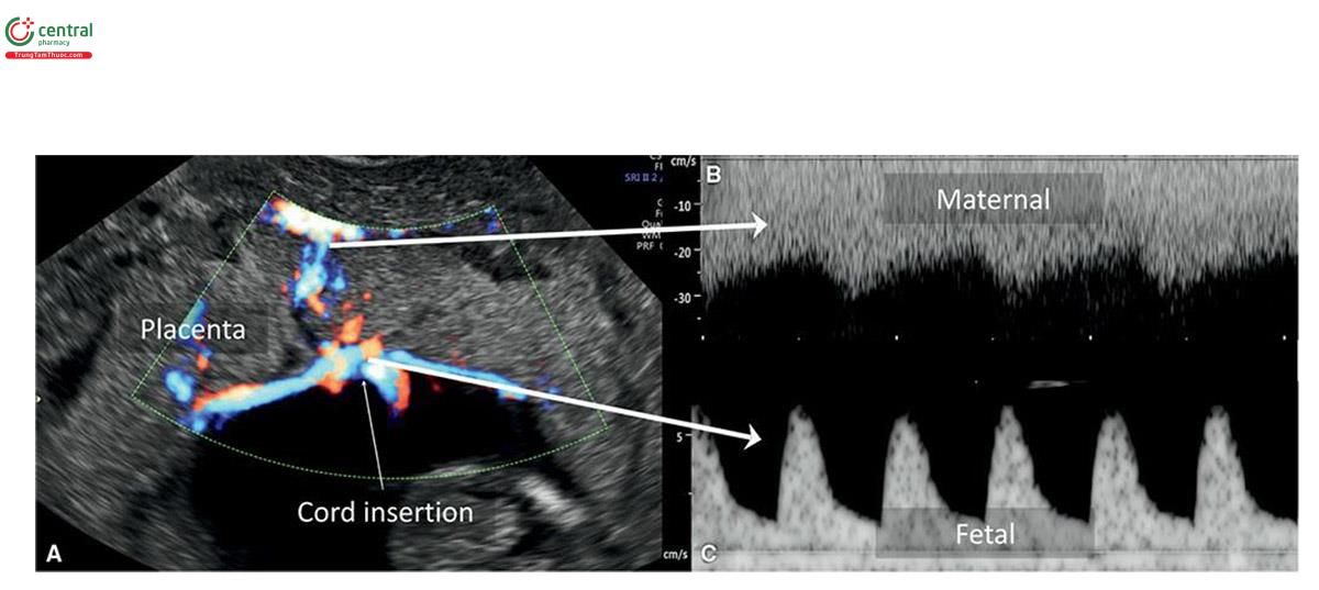 Hình 15.9: A: Siêu âm 2D với Doppler màu của bánh nhau lúc 12 tuần tuổi cho thấy tuần hoàn của mẹ và thai nhi ở mức dây rốn cắm vào. B và C: Doppler xung tương ứng của mạch máu mẹ và thai nhi. Lưu ý, có sự khác biệt về vận tốc dòng máu giữa tuần hoàn của mẹ và thai nhi, với tuần hoàn mẹ có trở kháng thấp. Cũng cần lưu ý, có sự khác biệt về tần số tim giữa 2 tuần hoàn.