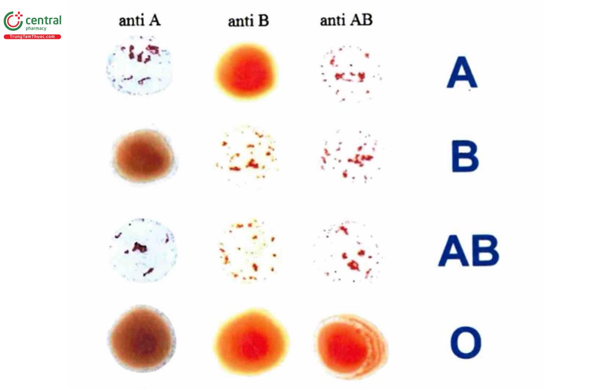 Hình 4.1. Hình ảnh bốn nhóm máu ABO xác định bằng phương pháp dùng huyết thanh mẫu (trực tiếp)