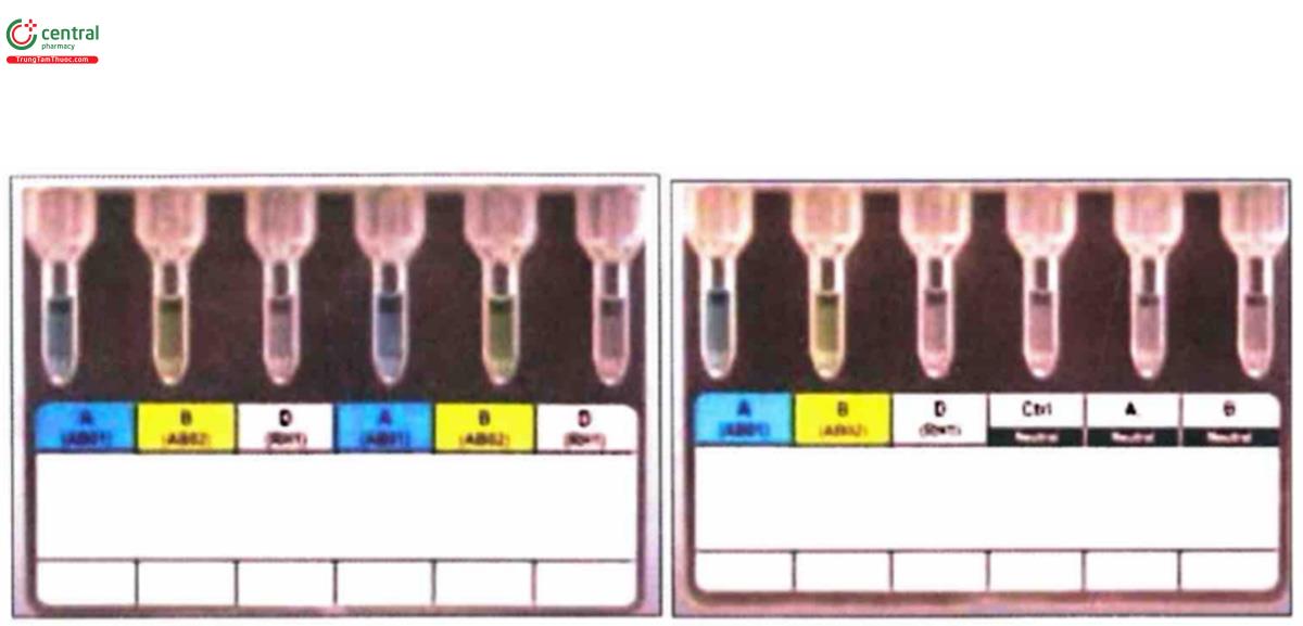 Hình 4.2. Card định nhóm máu bằng phương pháp trực tiếp (huyết thanh mẫu; hình trái) và card định nhóm máu bằng phương pháp trực tiếp và gián tiếp (huyết thanh mẫu và hồng cầu mẫu; hình phải)