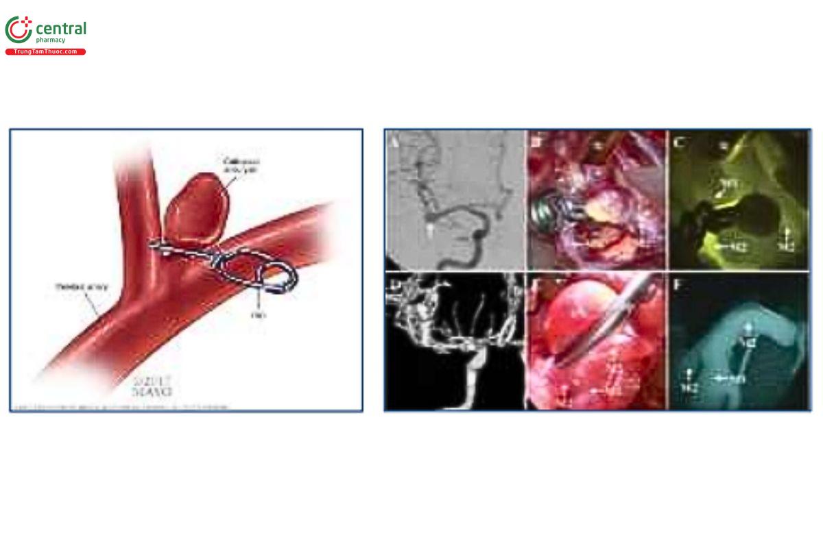 Hình 1. Vi phẫu thuật kẹp túi phình bằng clip và kiểm soát kết quả phẫu thuật bằng phương pháp sử dụng huỳnh quang ICG. (Nguồn: Brain Aneurysm Foundation)