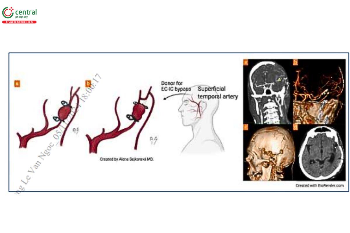 Hình 2. Phẫu thuật kẹp loại bỏ túi phồng và cầu nối ngoài sọ - trong sọ phục hồi tưới máu não (Nguồn: Brain Sciences-MDPI)