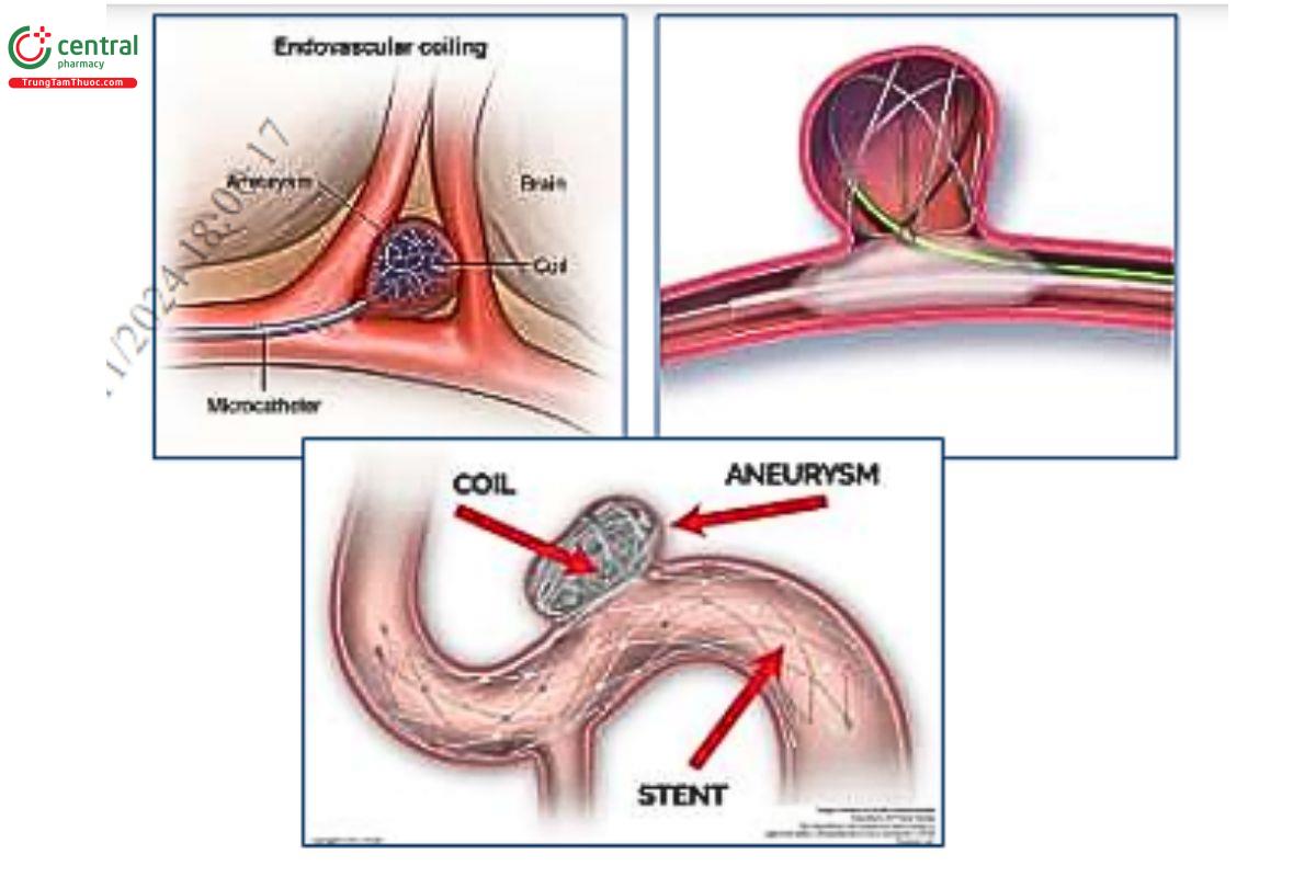 Hình 3. Các hình thái kỹ thuật cơ bản của phương pháp can thiệp nội mạch điều trị phình động mạch não: nút túi phình bằng vòng xoắn kim loại đơn thuần, có bóng chèn cổ túi và có stent hỗ trợ. (Nguồn Ohio Stroke)