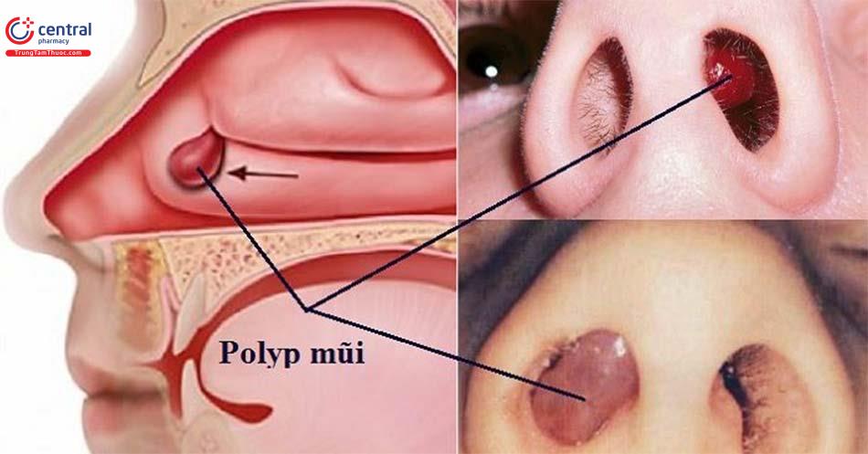 Polyp mũi xoang