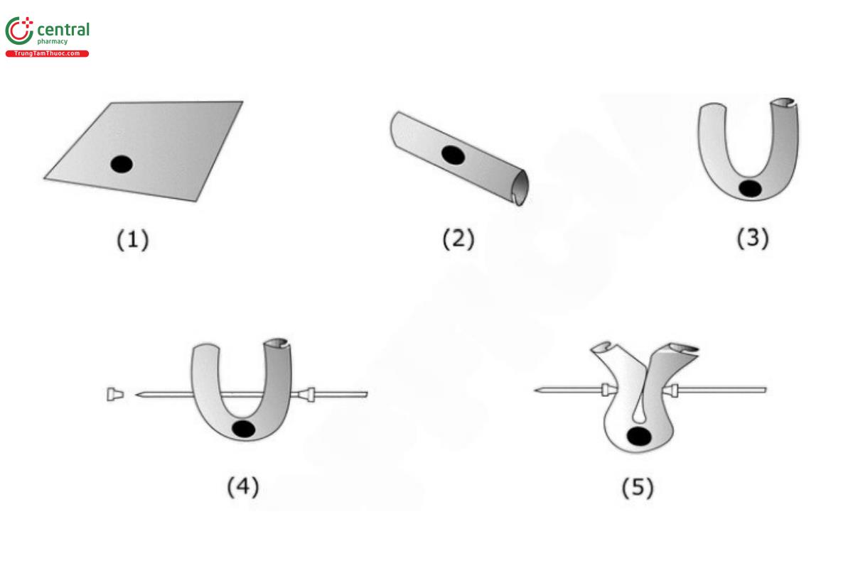 Pseudoephedrine Hydrochloride Extended-Release Tablets