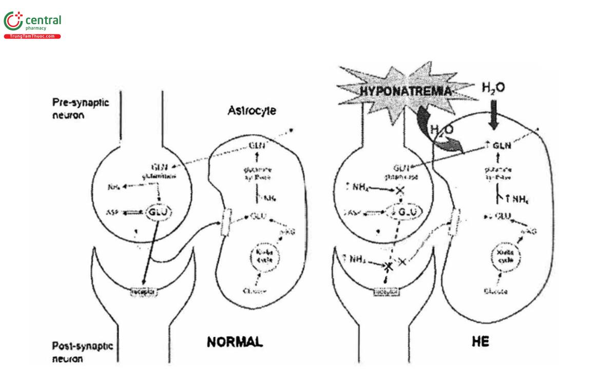 Hình 5: Tác động của tăng Amonia và hạ Natri máu trên tế bào thần kinh đệm ởngười bình thường và bệnh não gan