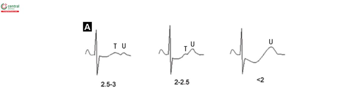 Hình 7A. Lưu ý sự dẹt dần của sóng T, rộng dần của sóng U và chênh xuống của đoạn ST liên quan tới giảm nồng độ K máu (K máu được tinh theo mEq/L)