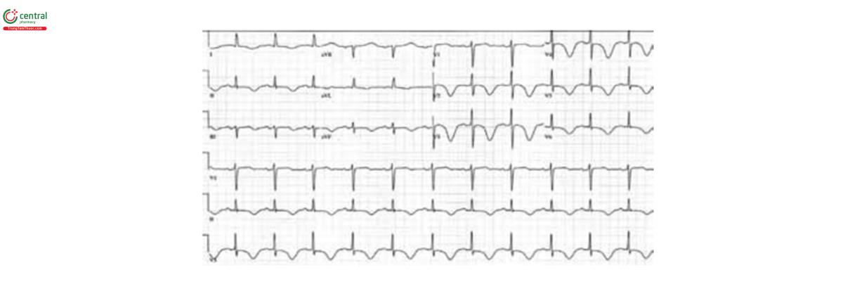 Hình 8. T âm ở nhiều chuyến đạo kèm QT dài ở bệnh nhân nữ 70t biểu hiện ngất và tăng men tim. Chụp mạch vành cho thấy hẹp 90% đoạn xa của thân chung cho tới đoạn gần của liên thất trước và động mạch mũ.