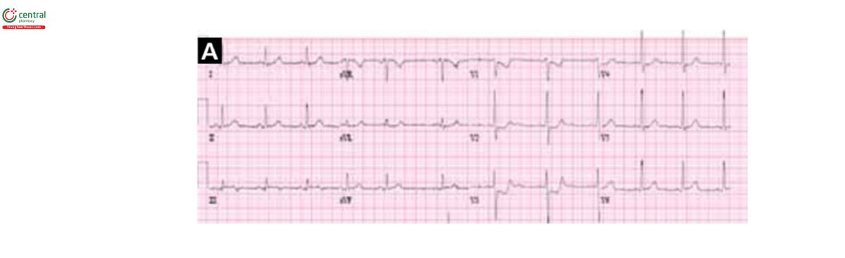 Hình 5A. ST chênh xuống ở các chuyến đạo trước tim V1-V4, chênh nhiều nhất ở V3, ở bệnh nhân xuất hiện đau ngực khởi phát 3h qua. Điều này gợi ý nhồi máu cơ ti ST chênh lên thành sau. Ở đây cũng có ST chênh lên bán cấp ở DIII, những dấu hiệu này cho phép chẩn đoán nhồi máu cơ tim thành dưới. Chụp mạch vành cấp cứu cho thấy tắc hoàn toàn đoạn giữa động mạch mũ. 