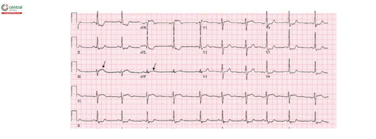 FIGURE 6. Example of subtle ST-segment elevation in two contiguous leads with a prominent ST-segment depression in other leads. The ST segment is depressed in leads I and aVL and V4, Vs, and Vo. There is a subtle ST-segment elevation with a broad hyperacute T wave in leads III and aVF fused with the ST segment in a convex fashion (arrows), suggesting that the primary abnormality is actually an acute inferior injury. Coronary arteriography showed a totally occluded right coronary artery in its mid-segment and severe left circumflex disease. The ST-segment depression is partly reciprocal to the inferior injury and partly a reflection of left circumflex-related ischemia.