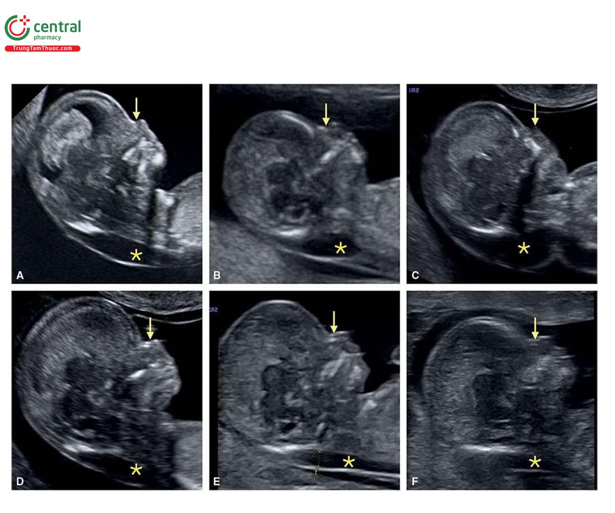 Hình 6.1: Mặt cắt dọc giữa mặt ở 6 thai nhi bị trisomy 21 từ 11 đến 13 tuần tuổi. Lưu ý, các độ mờ da gáy có kích thước khác nhau (dấu hoa thị) và không có (A, C, F) hoặc tình trạng cốt hóa kém (B, D, E) của xương mũi (mũi tên).