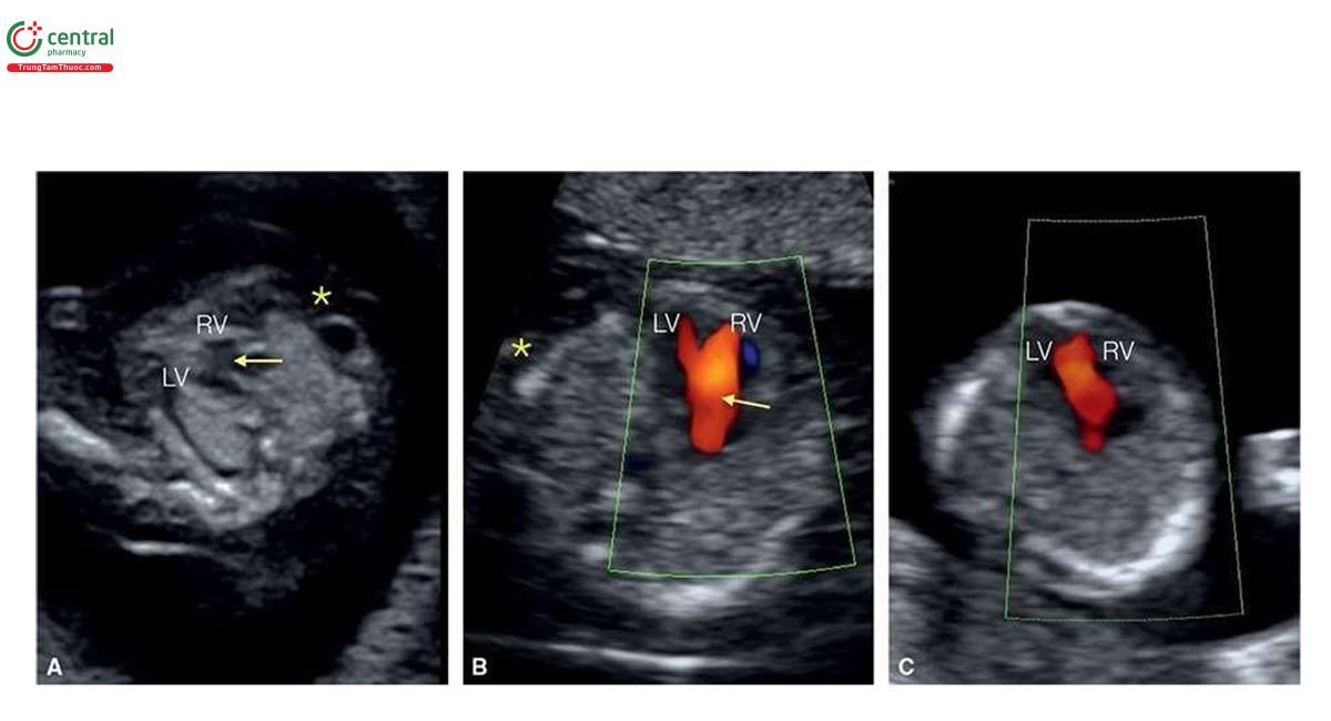 Hình 6.10: Mặt cắt ngang ngực ở 3 thai nhi (A - C) bị trisomy 18 và dị tật tim tương ứng ở tuổi thai 11, 13 và 13 tuần. Ở thai nhi A và B, thấy kênh nhĩ thất (AVSD) trên siêu âm 2D ở A (mũi tên) và Doppler màu ở B (mũi tên). Thai nhi C ban đầu dường như chỉ có tim một thất (univentricular heart), nhưng 1 tuần sau đó, siêu âm theo dõi xác nhận AVSD. Phù thai và phù dưới da (dấu hoa thị) thường thấy như ở A và B. LV, tâm thất trái; RV, tâm thất phải.