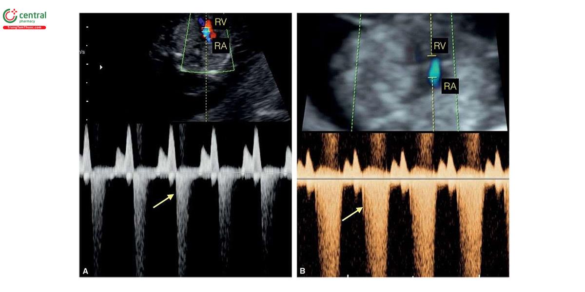 Hình 6.11: Thường gặp hở van tim ở thai nhi bị trisomy 18 trong quý 1. A: Doppler màu và xung qua van ba lá ở thai nhi 13 tuần tuổi bị trisomy 18 cho thấy hở van ba lá nhẹ (mũi tên). B: Doppler màu và xung qua van ba lá ở thai nhi 13 tuần tuổi bị trisomy 21 cho thấy hở van ba lá nặng (mũi tên). RA, tâm nhĩ phải; RV, tâm thất phải.