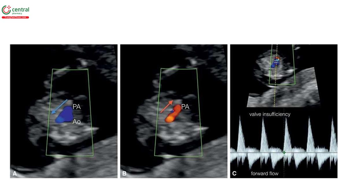 Hình 6.12: Mặt cắt ba mạch máu-khí quản với Doppler màu và xung ở thai nhi 12 tuần tuổi với van động mạch phổi loạn sản hoặc đa van (dysplastic or polyvalvular pulmonary valve) có hẹp và hở, một dấu hiệu điển hình của trisomy 18 và 13. A: Dòng chảy xuôi dòng (antegrade flow) qua động mạch phổi (PA) trong thì tâm thu (mũi tên xanh lam). B: Dòng chảy ngược (retrograde flow) qua PA trong thì tâm trương (mũi tên đỏ). C: Doppler xung qua PA cho thấy dòng chảy hai chiều (bidirectional flow). Dấu hiệu này cũng có thể ảnh hưởng đến van động mạch chủ và thường kèm theo phù thai và thai chết lưu (fetal demise). Ao, động mạch chủ.