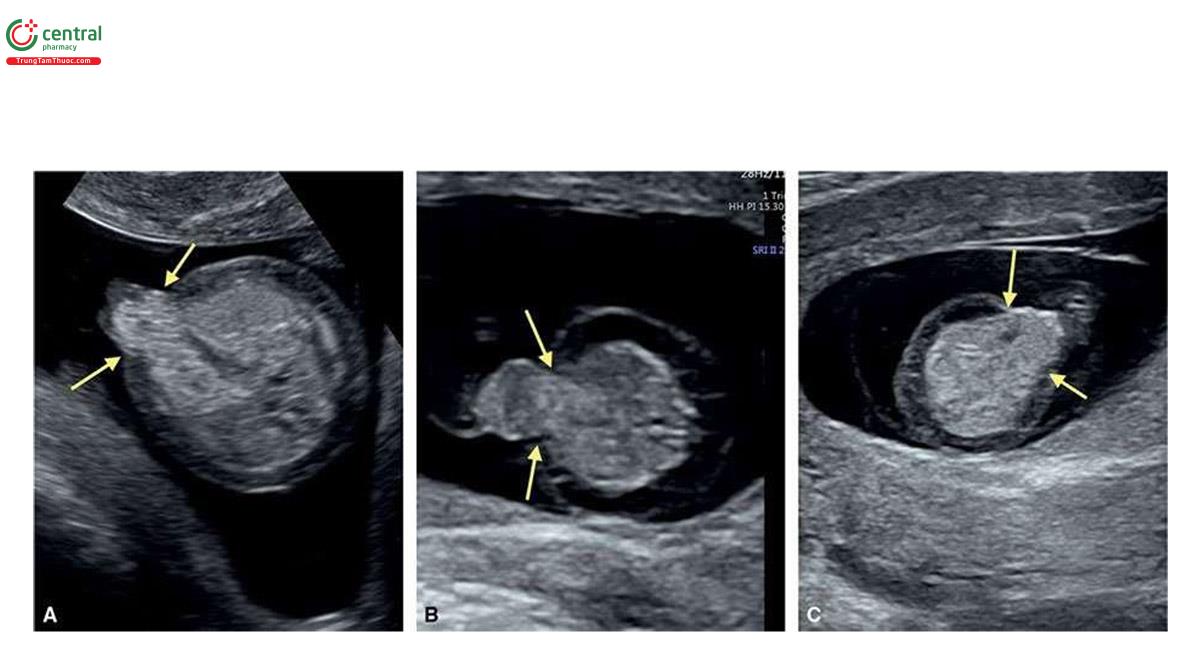 Hình 6.13: Mặt cắt ngang bụng ở mức dây rốn cắm vào ở 3 thai nhi (A - C) tương ứng 13, 12 và 12 tuần tuổi bị trisomy 18. Lưu ý, có thoát vị rốn (các mũi tên) ở mỗi thai nhi, đây là một dấu hiệu điển hình của trisomy 18. Ở thai A và B, thoát vị rốn nhỏ với thành phần là ruột, thường thấy ở trisomy 18. Ở thai C, gan nằm trong túi thoát vị rốn. Lưu ý, tình trạng phù ở tất cả các thai nhi.