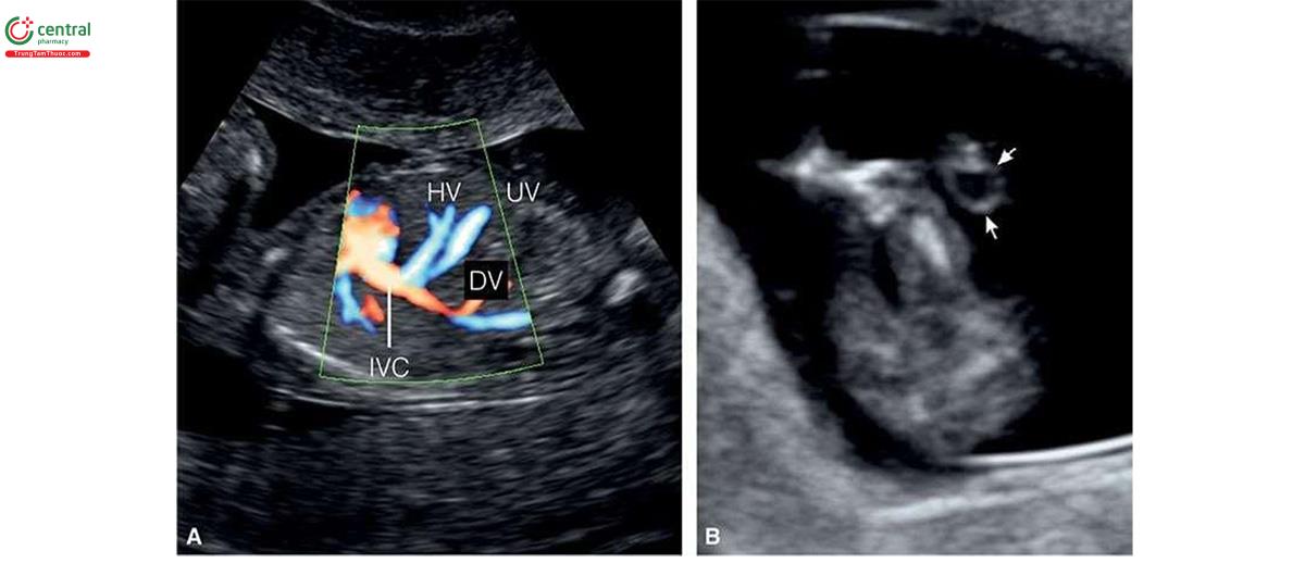 Hình 6.17: A: Mặt cắt dọc bên của bụng và ngực với Doppler màu ở thai nhi 12 tuần tuổi bị trisomy 18. Lưu ý, ống tĩnh mạch (DV) đổ trực tiếp vào tĩnh mạch chủ dưới (IVC) ở A. B: Mặt cắt ngang dây rốn trong khoang ối của một thai nhi 12 tuần tuổi khác bị trisomy 18. Lưu ý, nang dây rốn ở B (các mũi tên). Các bất thường về dây rốn và mạch máu dây rốn này là những dấu hiệu kín đáo gặp ở cả trisomy 18 và 13 (xem Hình 6.24). Các dị tật khác được phát hiện ở cả 2 thai nhi. HV, tĩnh mạch gan; UV, tĩnh mạch rốn.