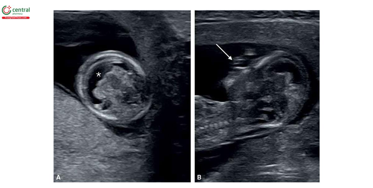 Hình 6.18: Mặt cắt ngang đầu (A) và mặt cắt dọc giữa mặt (B) ở thai nhi 12 tuần tuổi bị trisomy 13. Lưu ý, các bất thường sọ mặt điển hình với não thất duy nhất (holoproscephaly), cho thấy ở A (dấu hoa thị) và khe hở mặt nặng ở B (mũi tên).